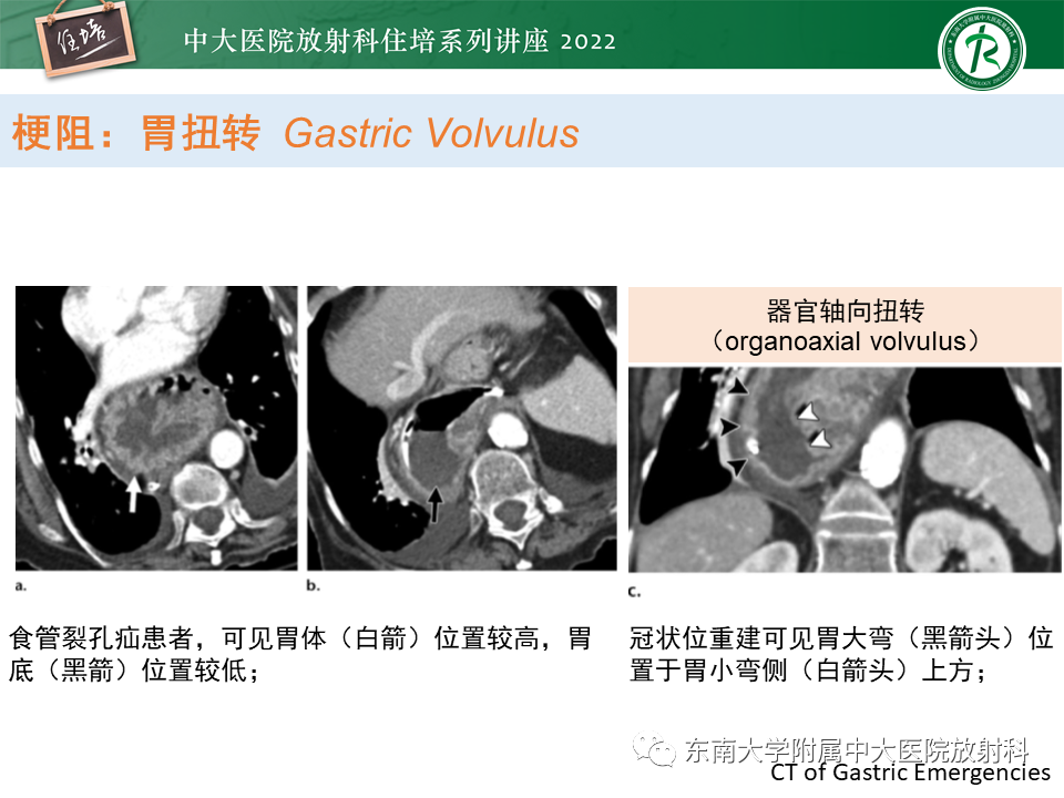 影像PPT - 【PPT】常见胃部急症的影像学征象分析-14