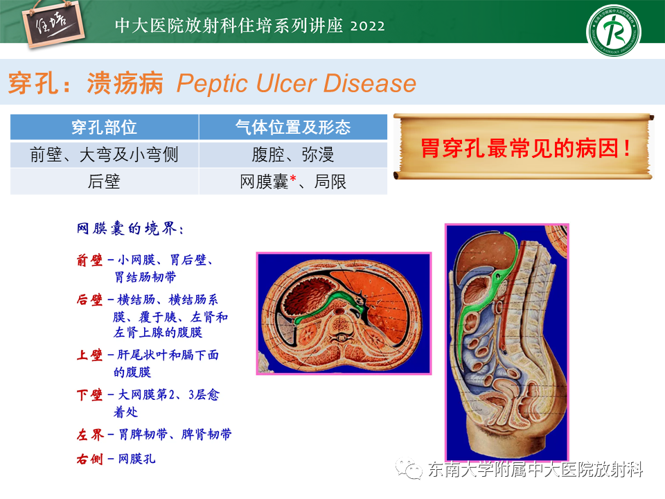 影像PPT - 【PPT】常见胃部急症的影像学征象分析-19