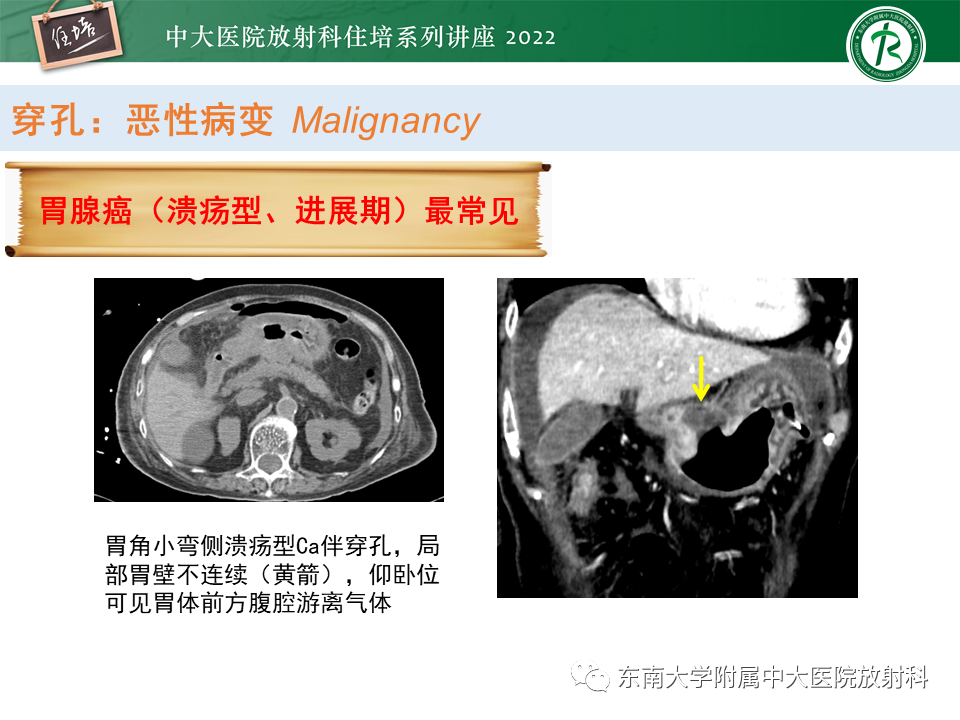影像PPT - 【PPT】常见胃部急症的影像学征象分析-20