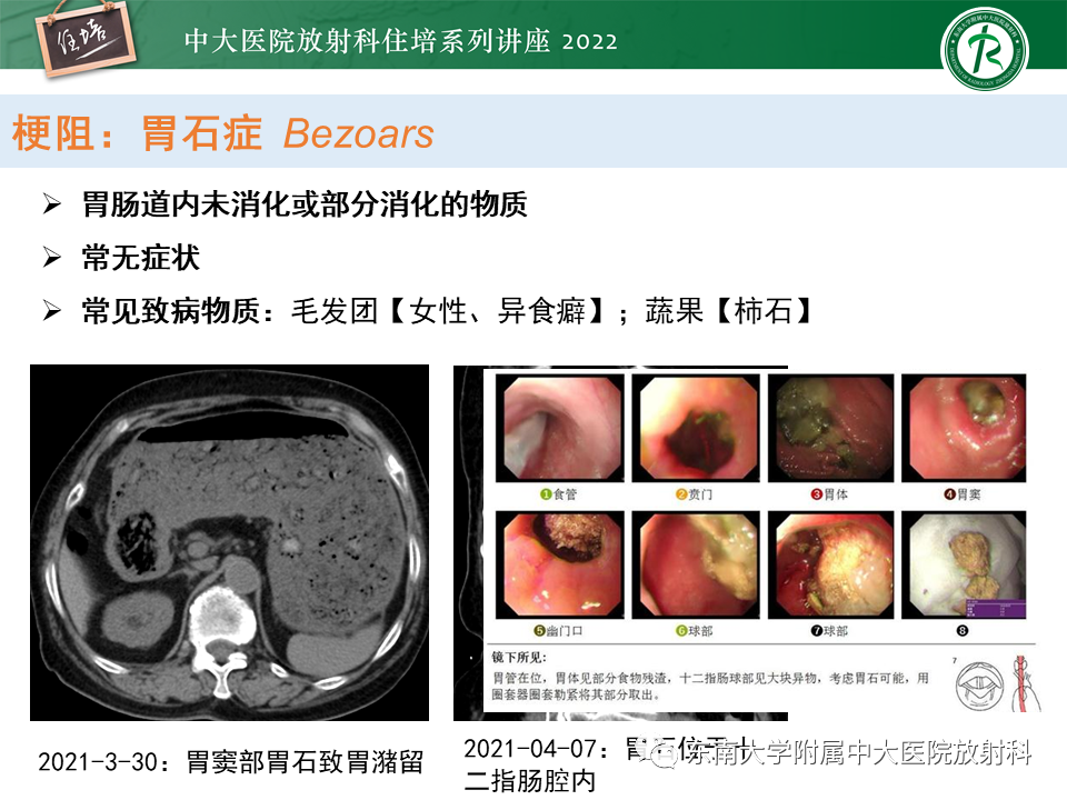 影像PPT - 【PPT】常见胃部急症的影像学征象分析-17