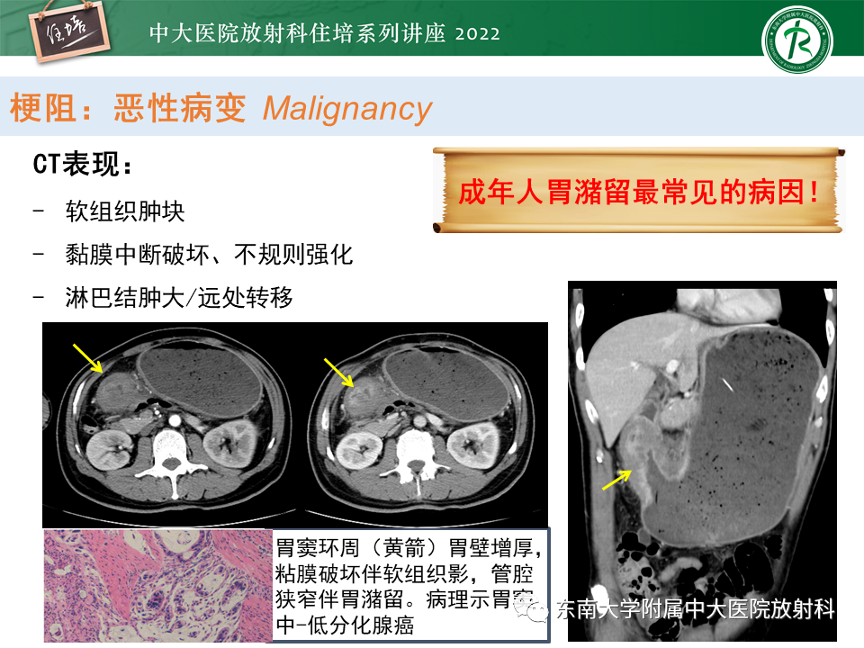 影像PPT - 【PPT】常见胃部急症的影像学征象分析-18