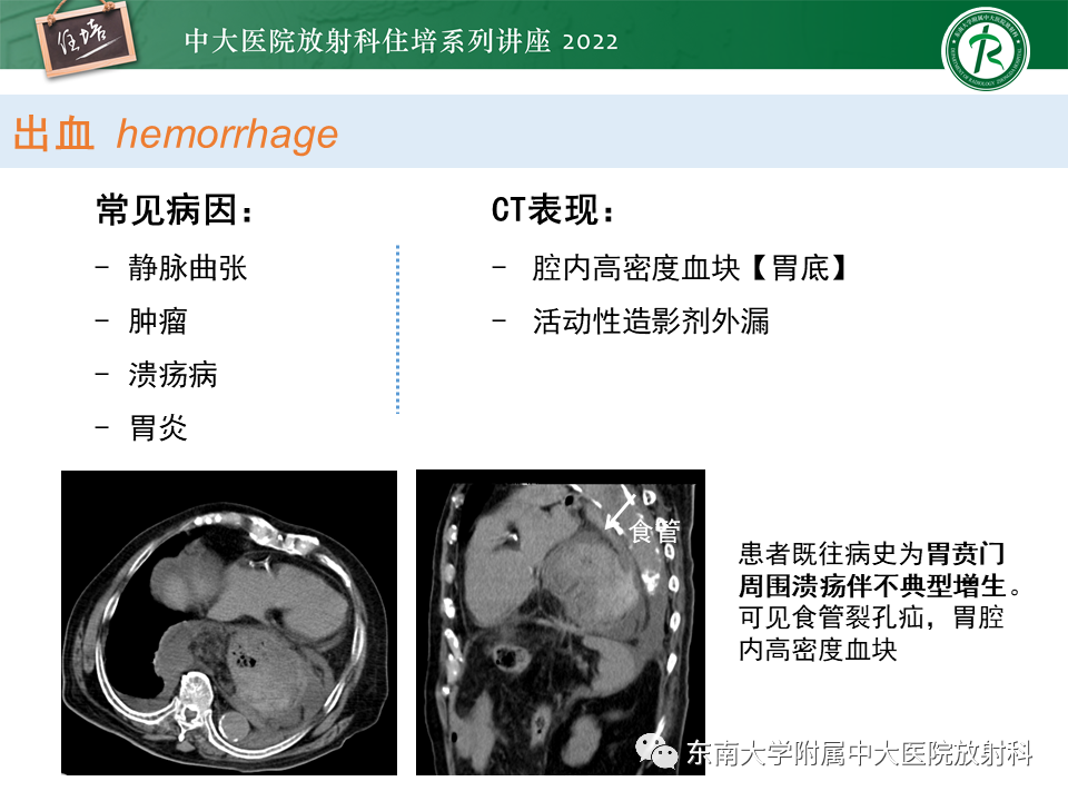 影像PPT - 【PPT】常见胃部急症的影像学征象分析-22