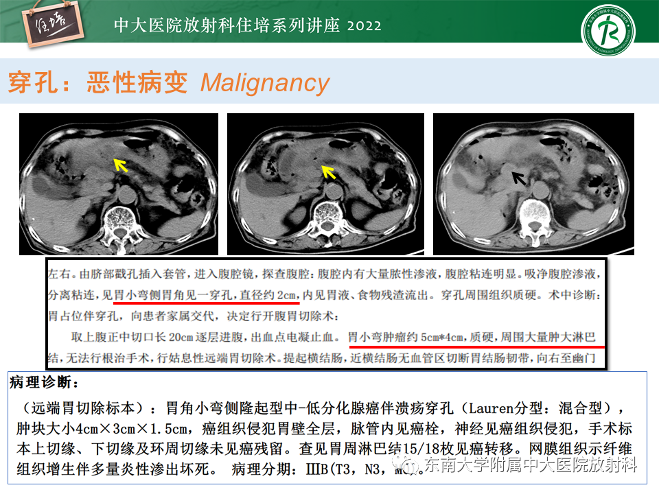 影像PPT - 【PPT】常见胃部急症的影像学征象分析-21