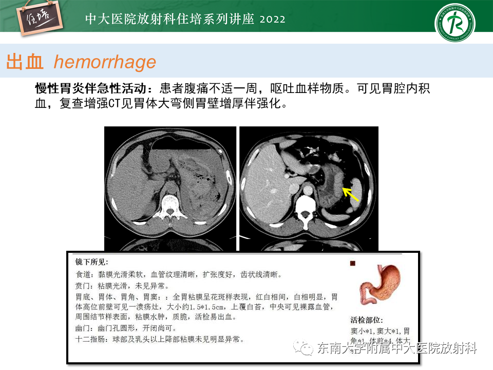 影像PPT - 【PPT】常见胃部急症的影像学征象分析-23