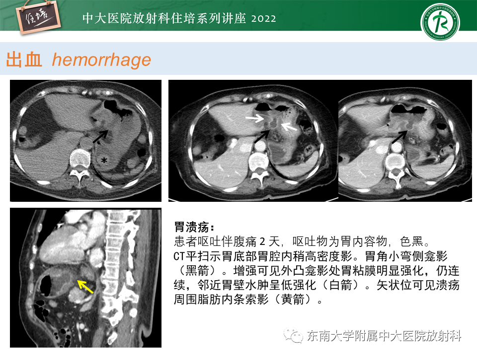 影像PPT - 【PPT】常见胃部急症的影像学征象分析-24