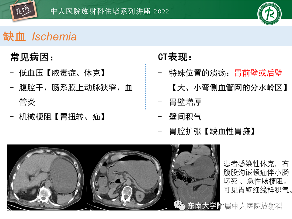 影像PPT - 【PPT】常见胃部急症的影像学征象分析-26