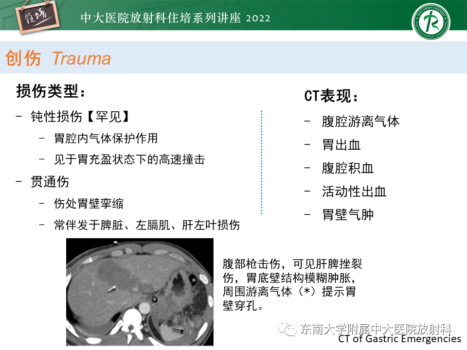 影像PPT - 【PPT】常见胃部急症的影像学征象分析-28