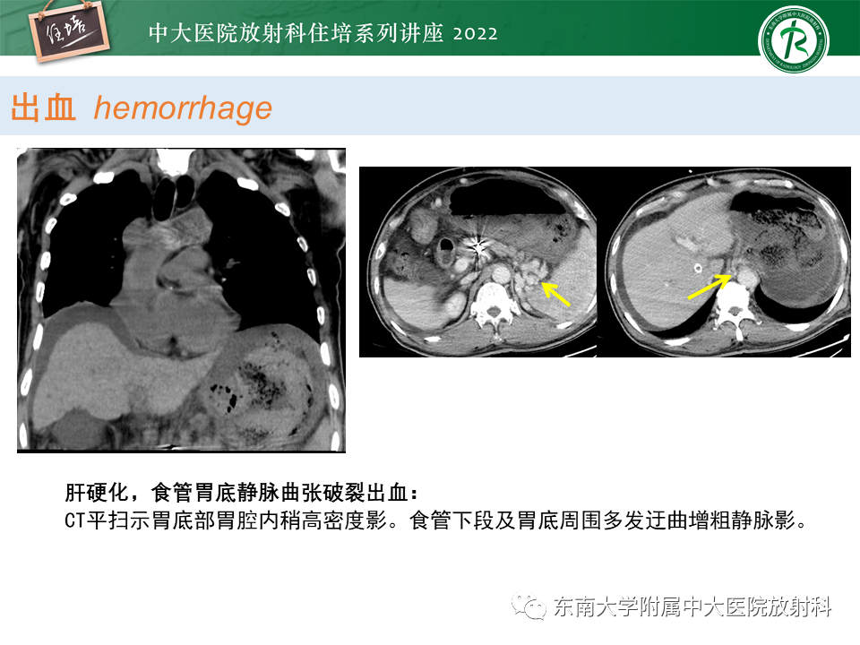 影像PPT - 【PPT】常见胃部急症的影像学征象分析-25