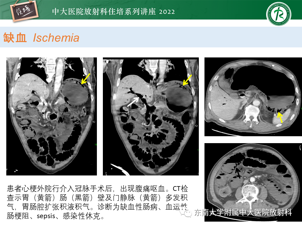 影像PPT - 【PPT】常见胃部急症的影像学征象分析-27