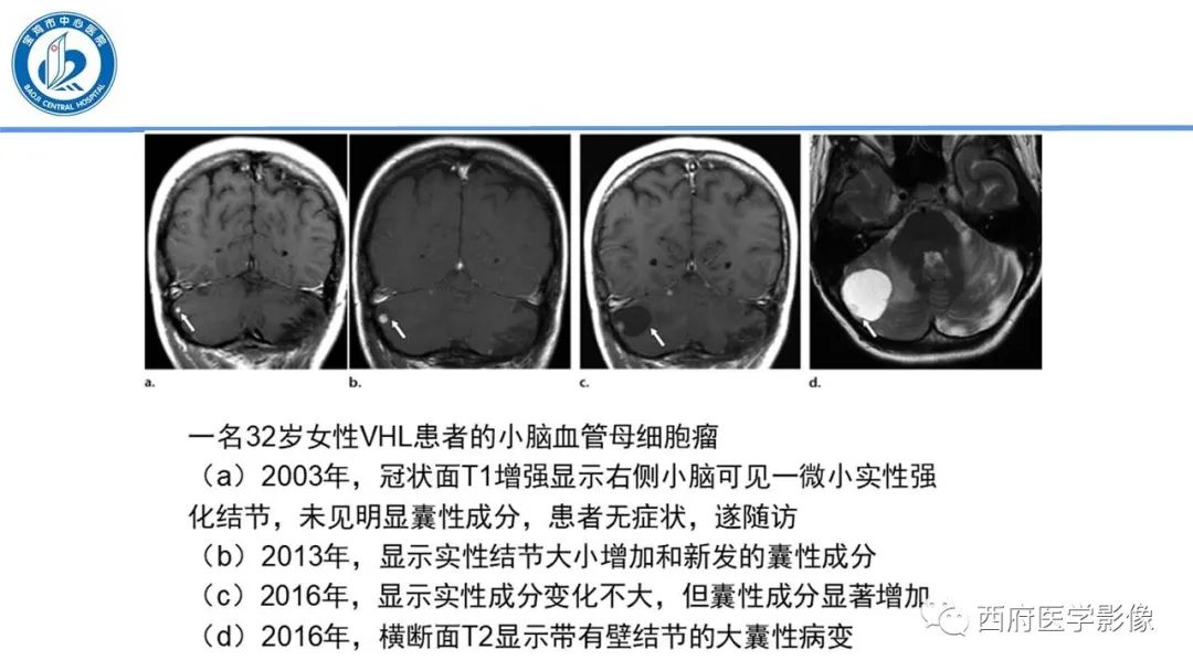 影像PPT - 【PPT】VHL综合征影像诊断-8