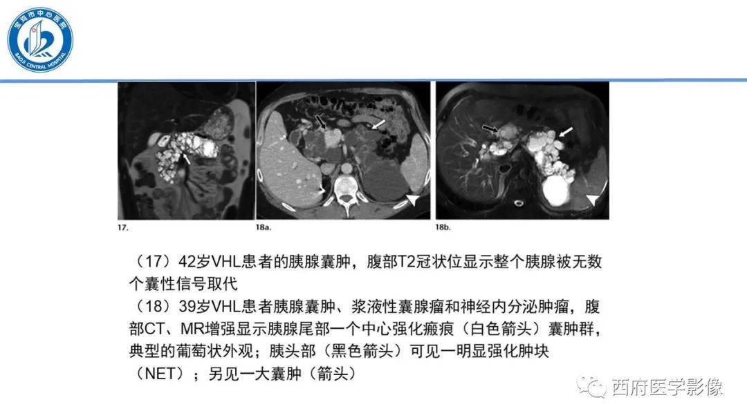 影像PPT - 【PPT】VHL综合征影像诊断-10