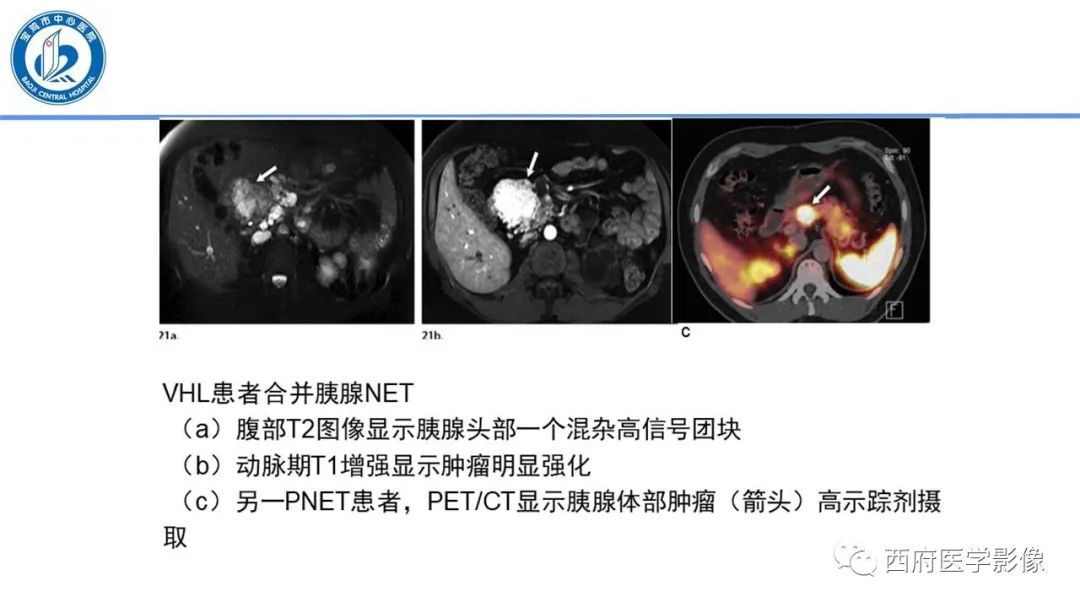 影像PPT - 【PPT】VHL综合征影像诊断-11