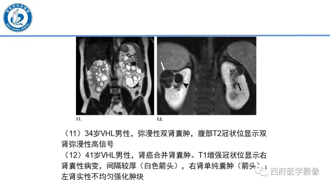影像PPT - 【PPT】VHL综合征影像诊断-13