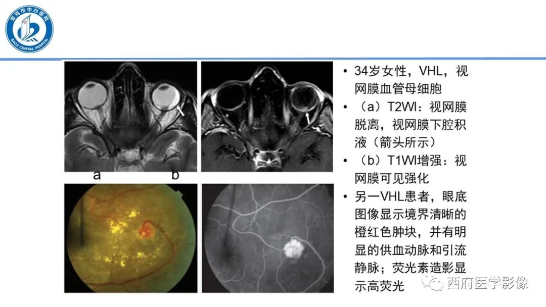 影像PPT - 【PPT】VHL综合征影像诊断-6