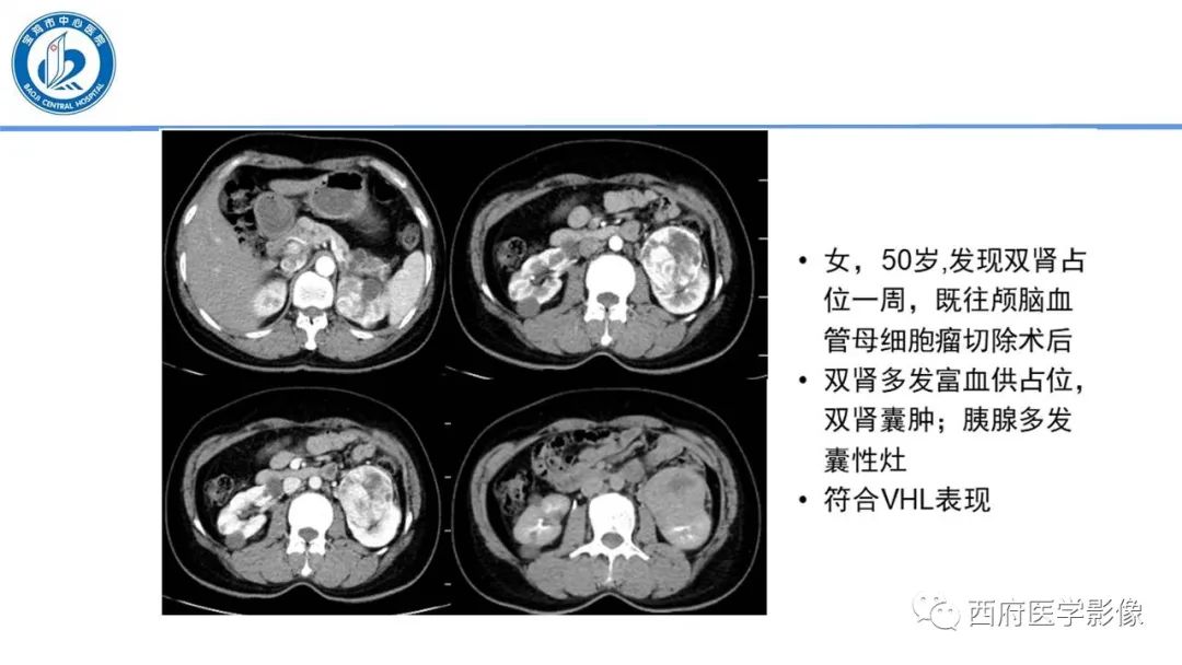 影像PPT - 【PPT】VHL综合征影像诊断-14