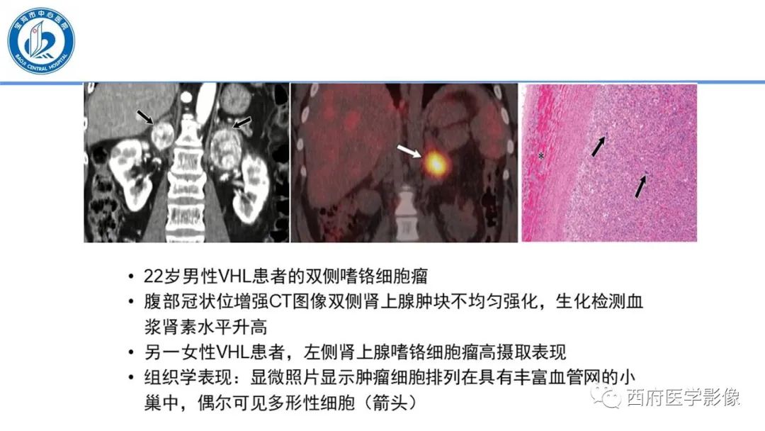 影像PPT - 【PPT】VHL综合征影像诊断-16