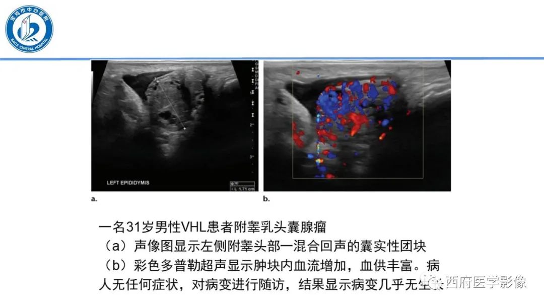 影像PPT - 【PPT】VHL综合征影像诊断-18