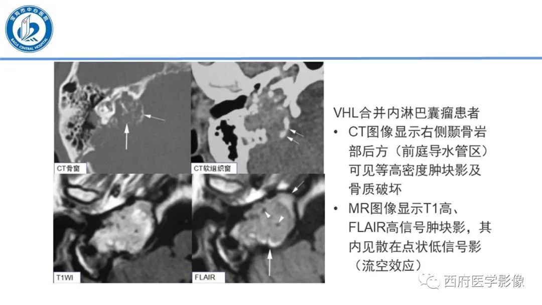 影像PPT - 【PPT】VHL综合征影像诊断-20
