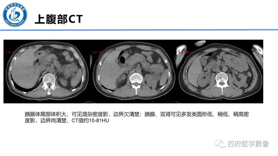 影像PPT - 【PPT】VHL综合征影像诊断-27