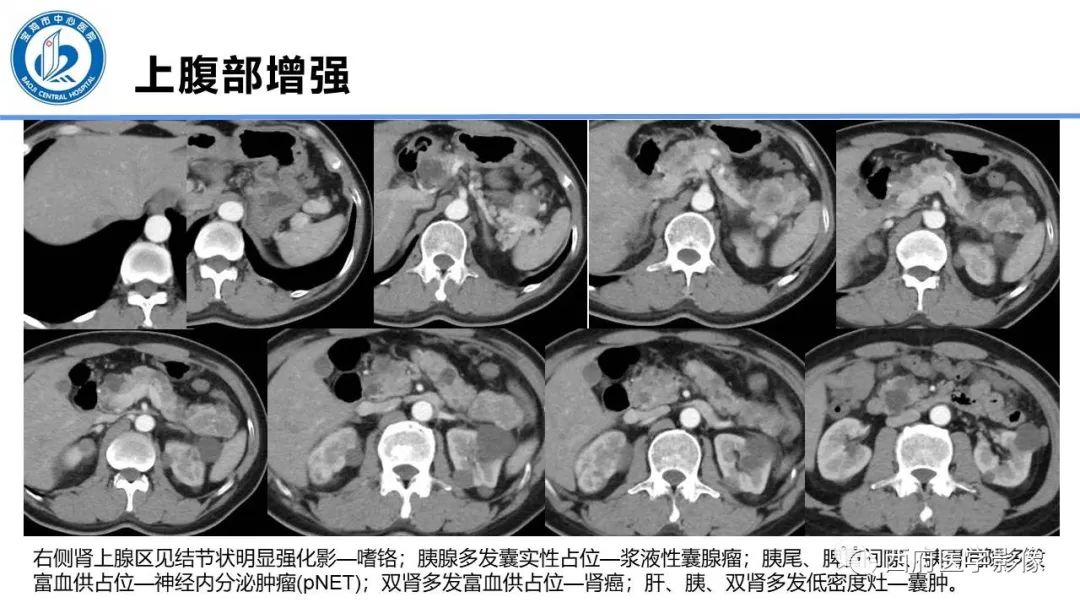 影像PPT - 【PPT】VHL综合征影像诊断-28