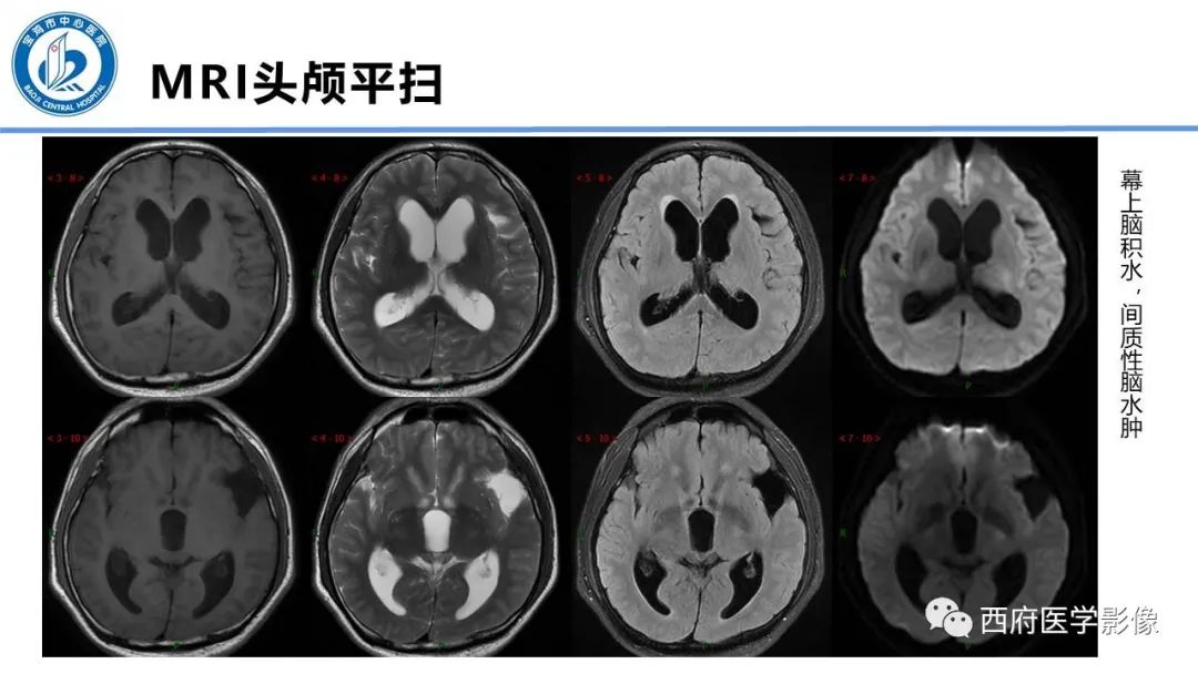 影像PPT - 【PPT】VHL综合征影像诊断-30