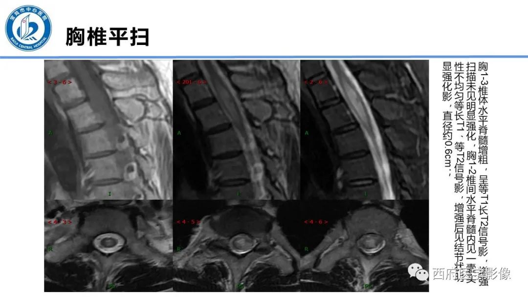 影像PPT - 【PPT】VHL综合征影像诊断-39