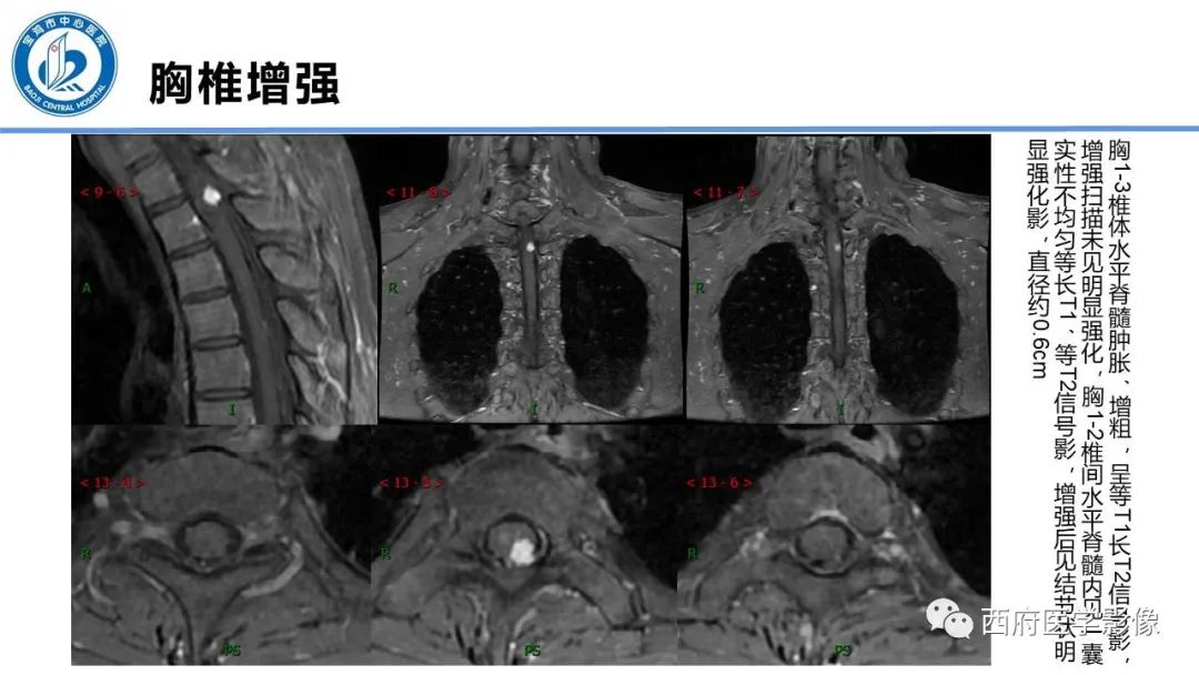 影像PPT - 【PPT】VHL综合征影像诊断-40