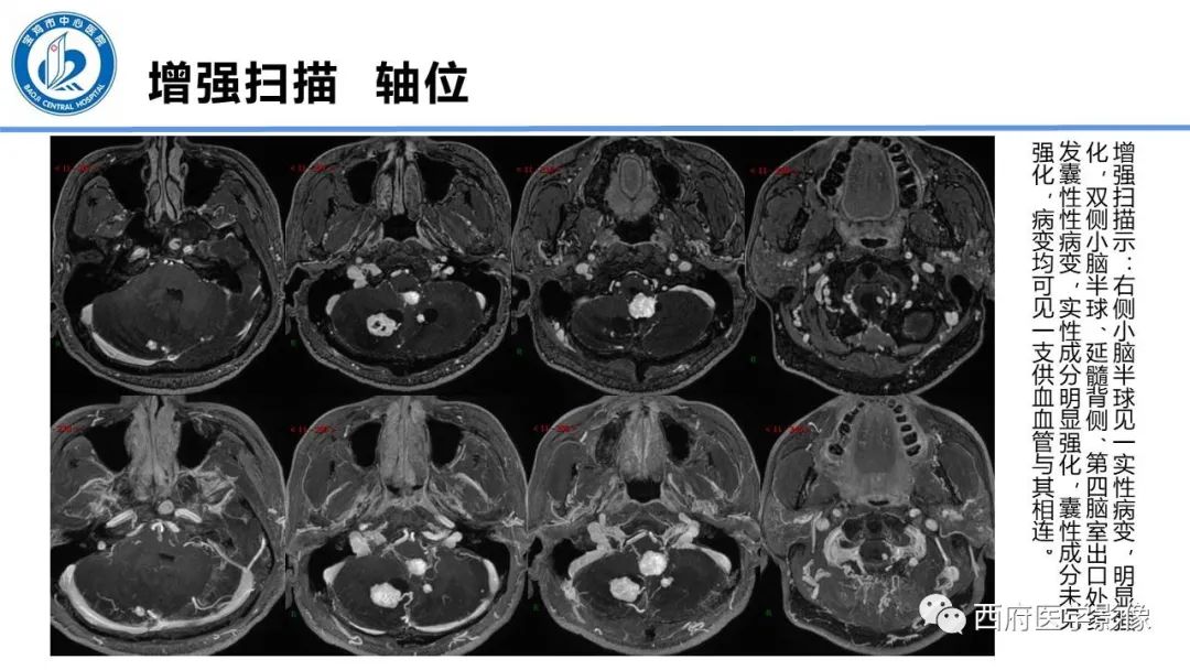 影像PPT - 【PPT】VHL综合征影像诊断-34