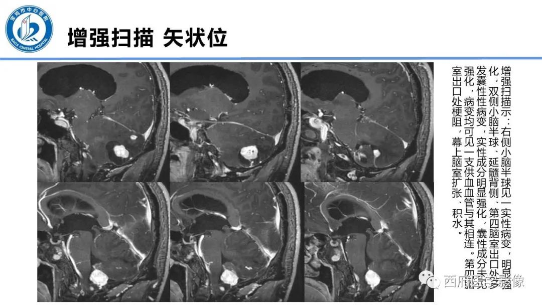 影像PPT - 【PPT】VHL综合征影像诊断-35