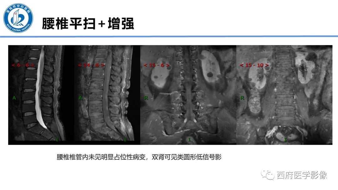 影像PPT - 【PPT】VHL综合征影像诊断-41