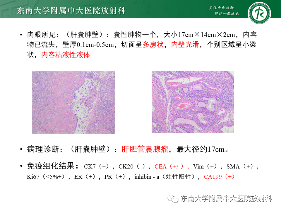 影像PPT - 【PPT】肝黏液性囊性肿瘤(MCN)-2