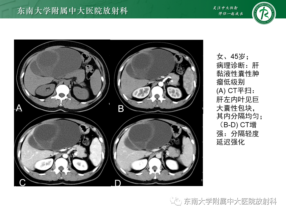 影像PPT - 【PPT】肝黏液性囊性肿瘤(MCN)-3