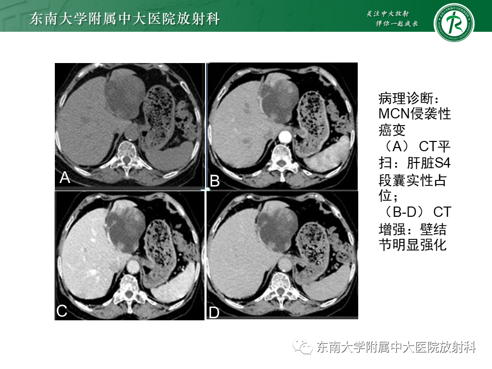 影像PPT - 【PPT】肝黏液性囊性肿瘤(MCN)-10