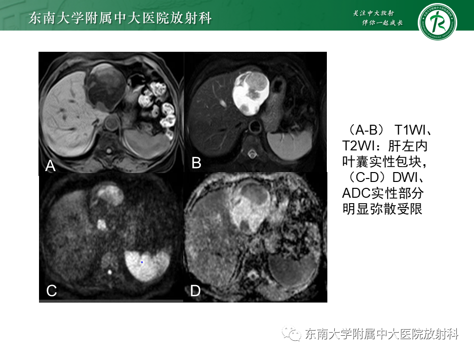 影像PPT - 【PPT】肝黏液性囊性肿瘤(MCN)-11