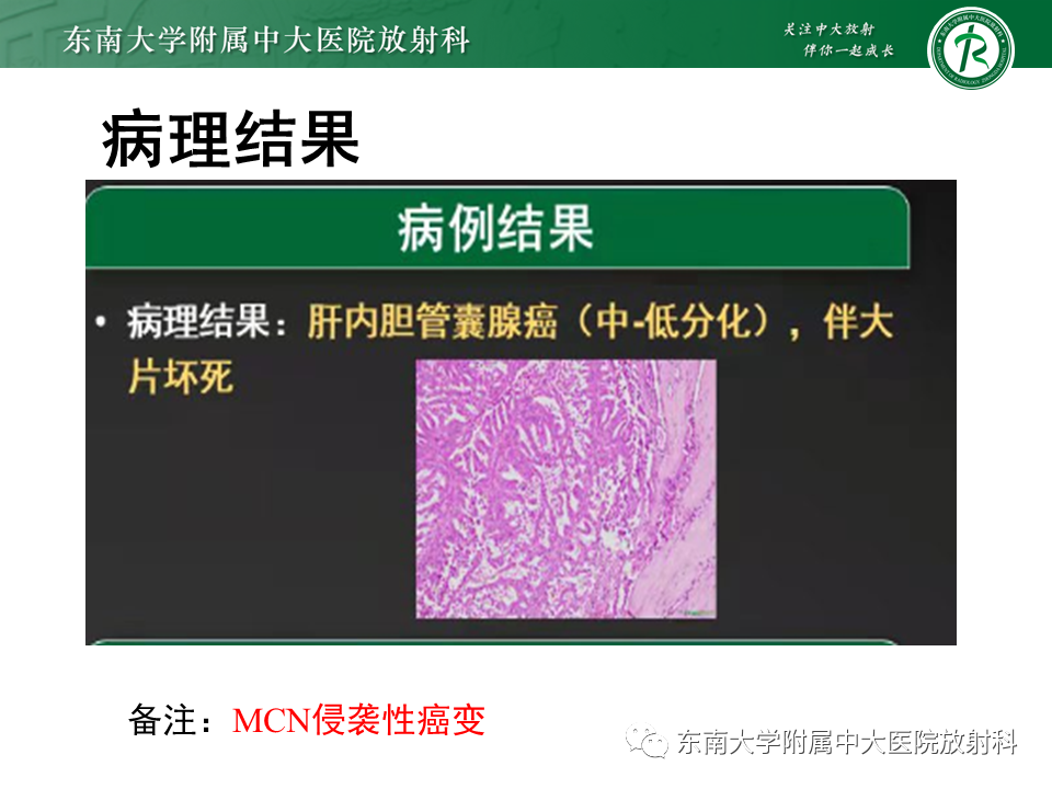 影像PPT - 【PPT】肝黏液性囊性肿瘤(MCN)-13