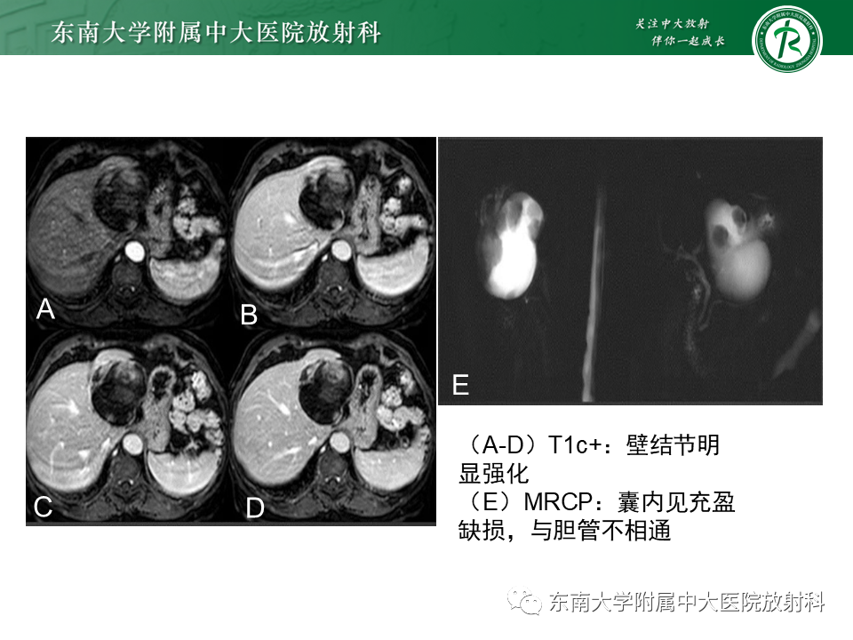 影像PPT - 【PPT】肝黏液性囊性肿瘤(MCN)-12