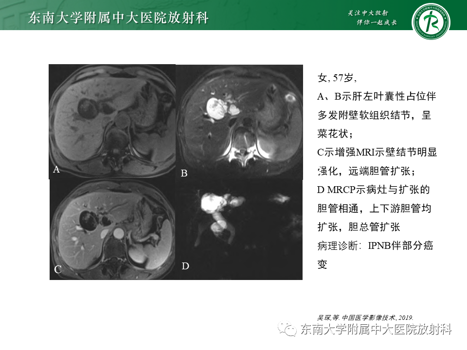 影像PPT - 【PPT】肝黏液性囊性肿瘤(MCN)-18