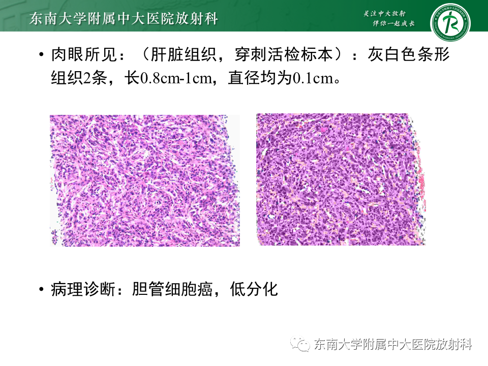 影像PPT - 【PPT】肝黏液性囊性肿瘤(MCN)-21