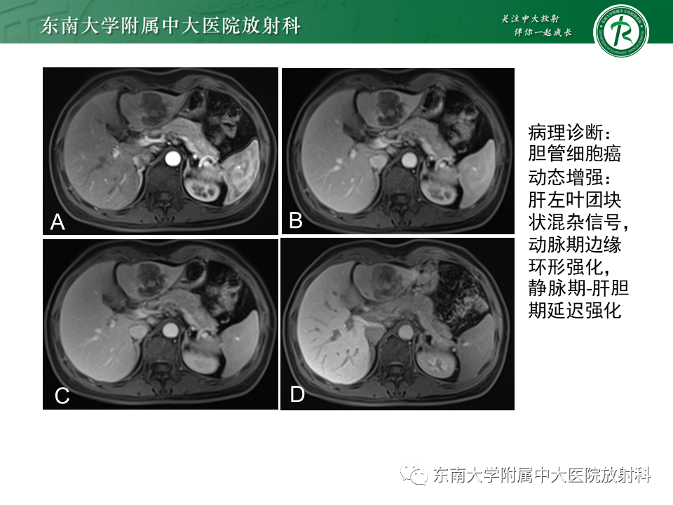 影像PPT - 【PPT】肝黏液性囊性肿瘤(MCN)-24