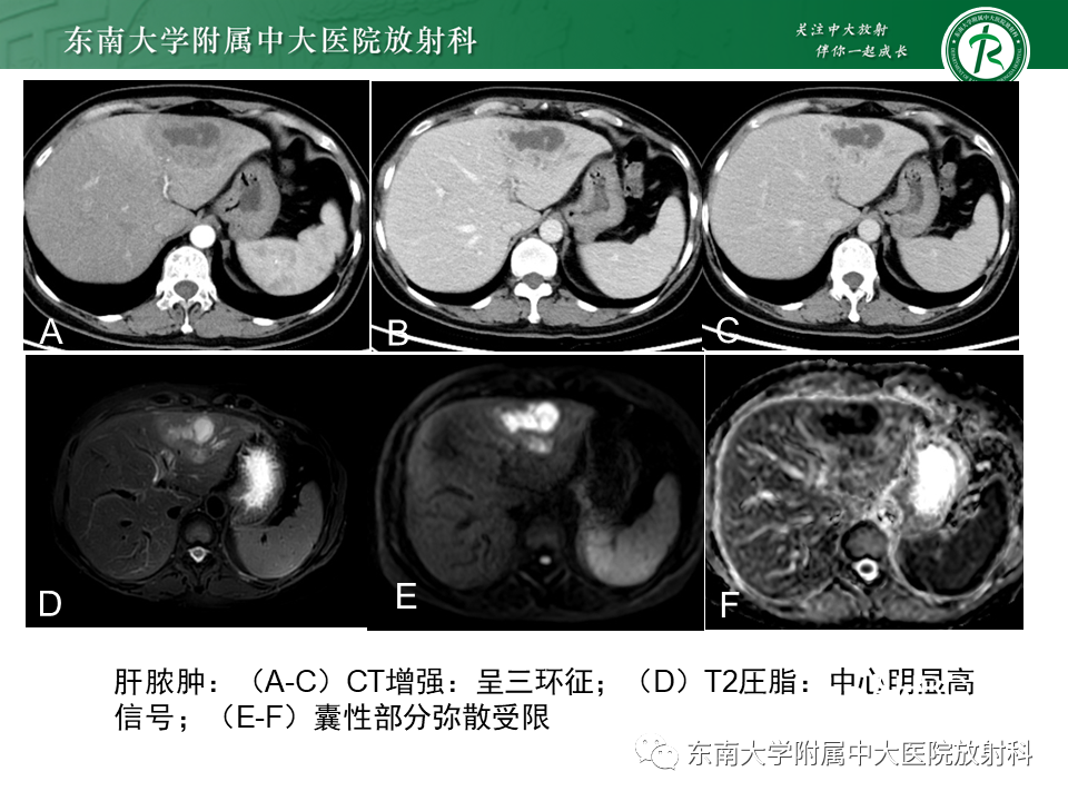 影像PPT - 【PPT】肝黏液性囊性肿瘤(MCN)-30