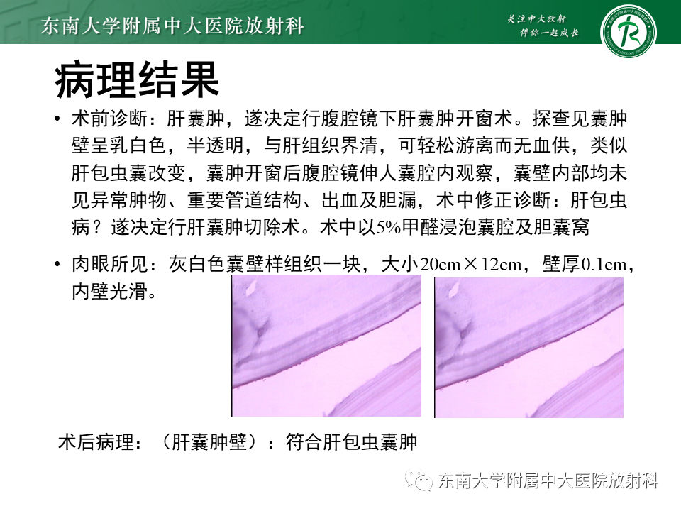 影像PPT - 【PPT】肝黏液性囊性肿瘤(MCN)-32