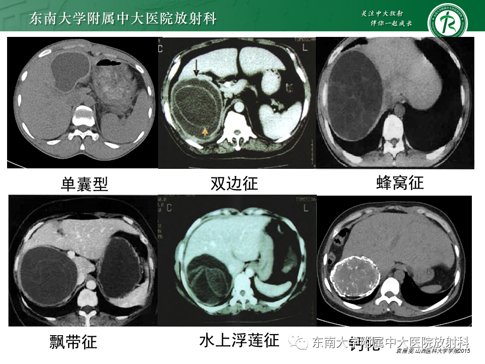 影像PPT - 【PPT】肝黏液性囊性肿瘤(MCN)-35