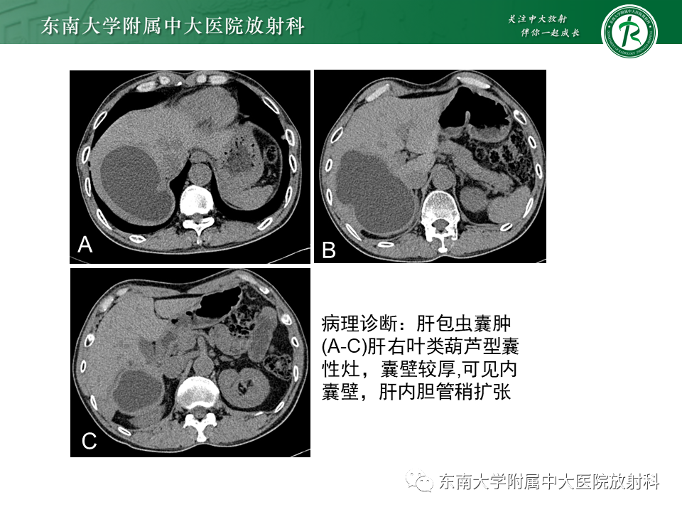 影像PPT - 【PPT】肝黏液性囊性肿瘤(MCN)-36