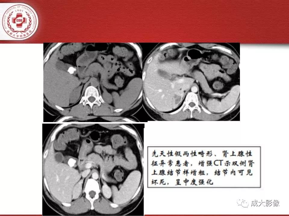 影像PPT - 【PPT】常见肾上腺疾病影像诊断-15