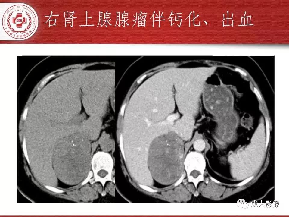 影像PPT - 【PPT】常见肾上腺疾病影像诊断-23