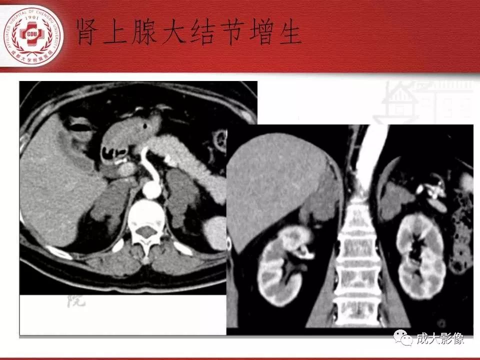 影像PPT - 【PPT】常见肾上腺疾病影像诊断-17