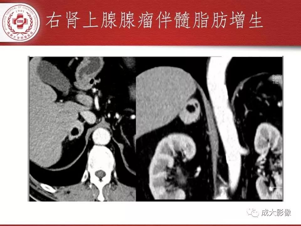 影像PPT - 【PPT】常见肾上腺疾病影像诊断-22