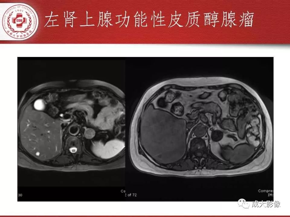 影像PPT - 【PPT】常见肾上腺疾病影像诊断-20
