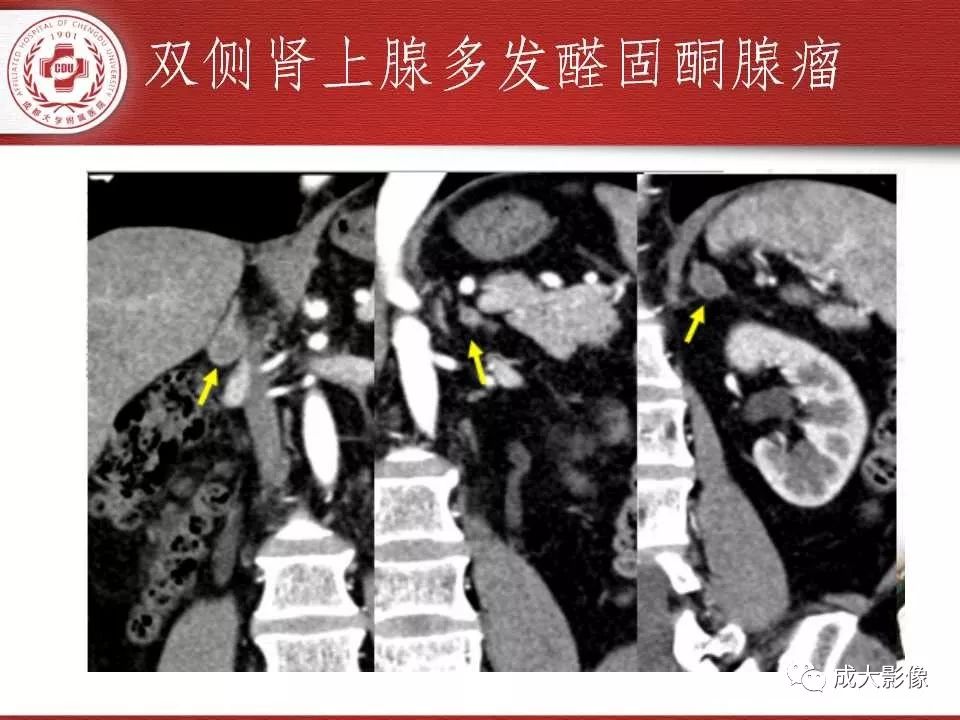影像PPT - 【PPT】常见肾上腺疾病影像诊断-21
