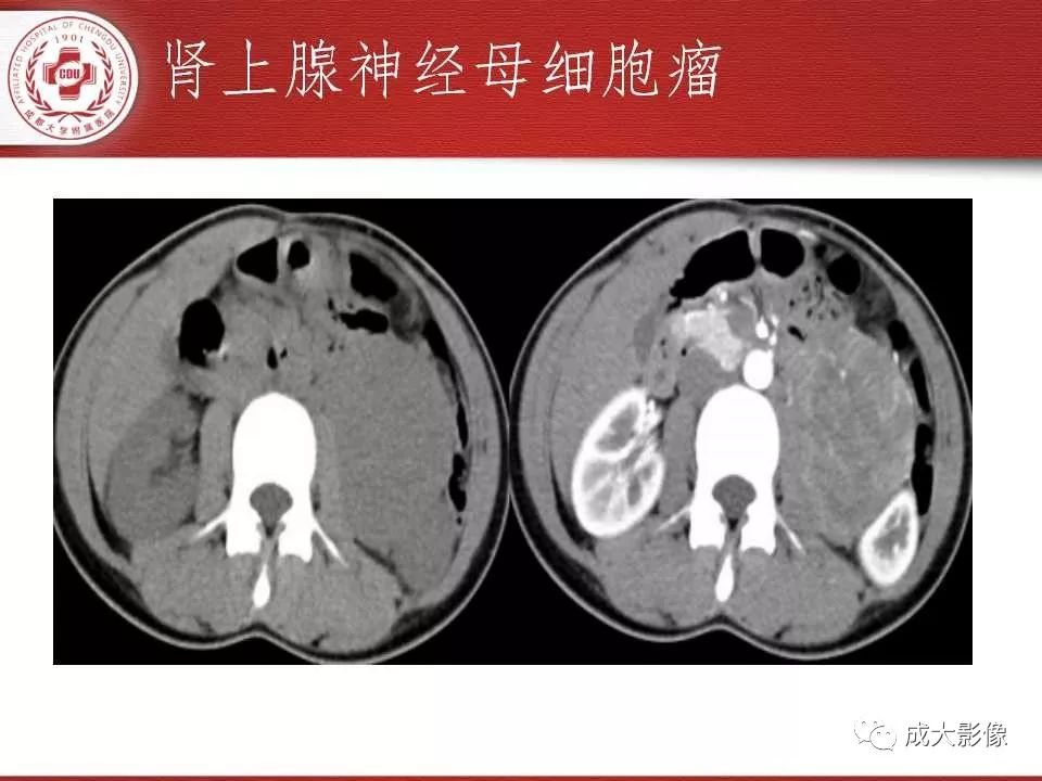 影像PPT - 【PPT】常见肾上腺疾病影像诊断-37